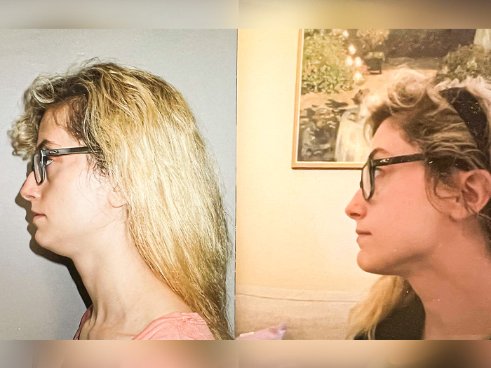 Mewing fast results adult chin before and after picture
